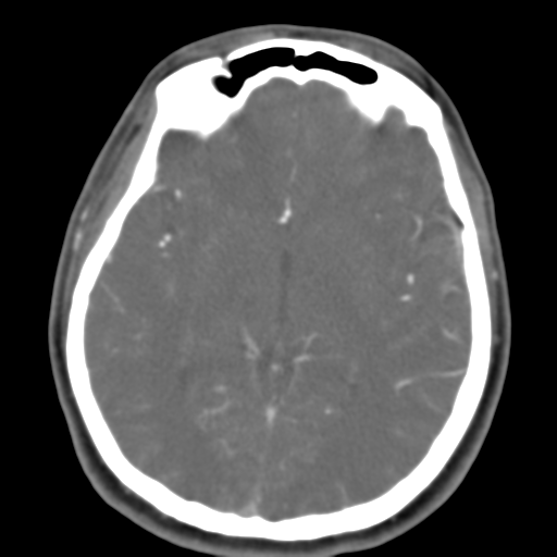 Carotico ophthalmic aneurysm (Radiopaedia 42916-46148 A 29).png