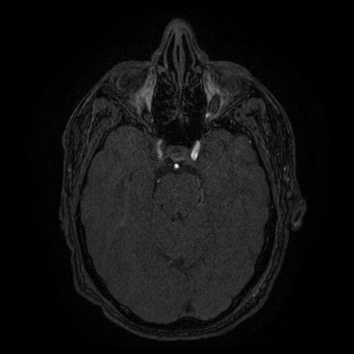 File:Carotid arterial dissection with acute cerebral infarction (Radiopaedia 26636-26784 MRA 111).jpg