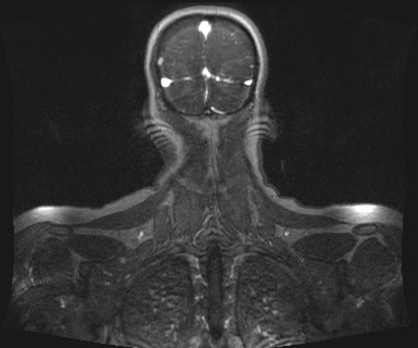 Carotid body tumor (Radiopaedia 12777-12912 MRA 71).jpg