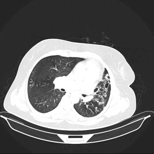 File:Carotid body tumor (Radiopaedia 21021-20948 Axial lung window 19).jpg