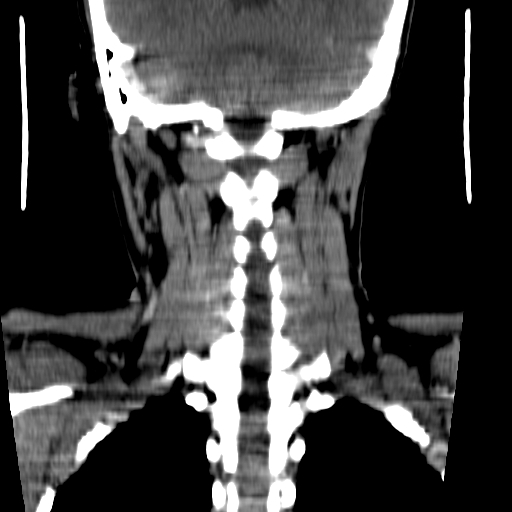 File:Carotid body tumor (Radiopaedia 27890-28124 B 1).jpg