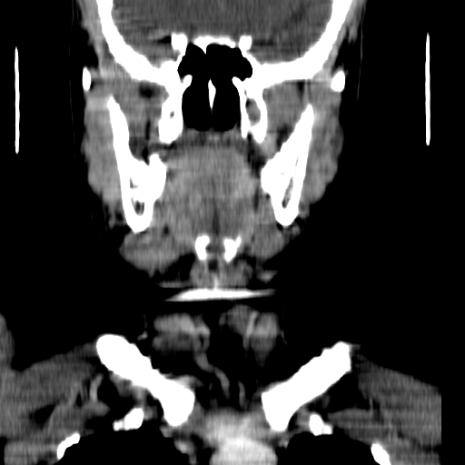 File:Carotid body tumor (Radiopaedia 27890-28124 B 15).jpg