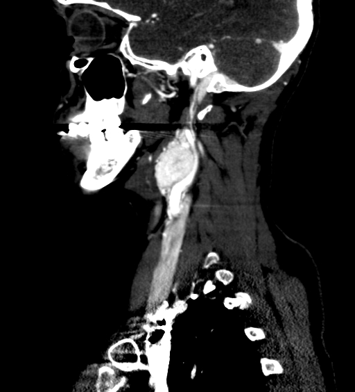 File:Carotid body tumor (Radiopaedia 39845-42300 D 26).jpg