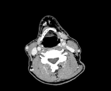Carotid body tumor (Radiopaedia 61750-69757 Axial Post contrast 62).jpg