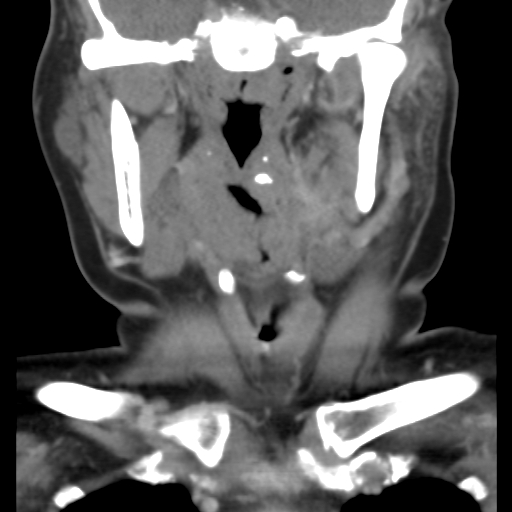 File:Carotid body tumor (paraganglioma) (Radiopaedia 38586-40729 B 19).jpg