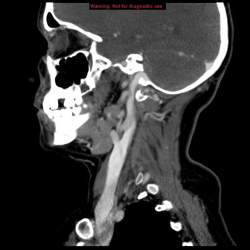 File:Carotid body tumor with lung metastases (Radiopaedia 9301-9986 Sagittal C+ delayed 16).jpg