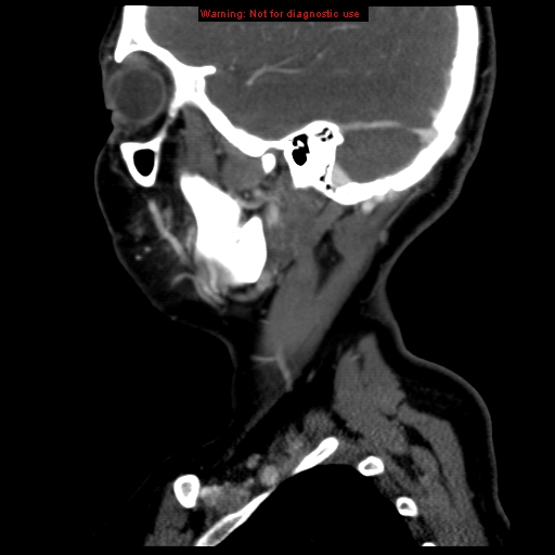 File:Carotid body tumor with lung metastases (Radiopaedia 9301-9986 Sagittal C+ delayed 9).jpg