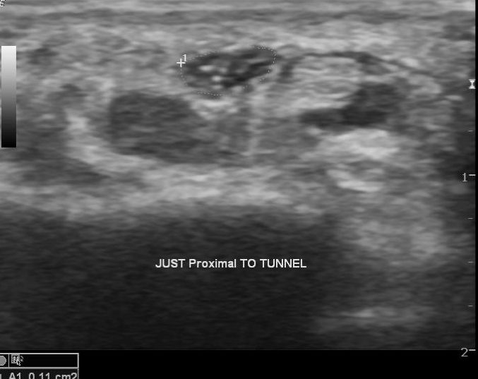 File:Carpal tunnel syndrome - with inverted notch sign (Radiopaedia 25567-25760 B 1).jpg