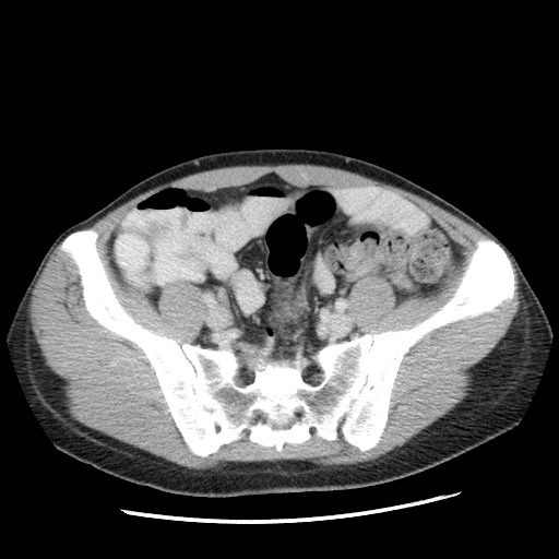 Castleman disease with fibrous pseudotumor in the abdomen (Radiopaedia 77296-89373 A 94).jpg
