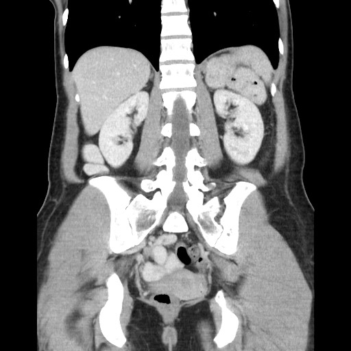 Castleman disease with fibrous pseudotumor in the abdomen (Radiopaedia 77296-89373 B 66).jpg
