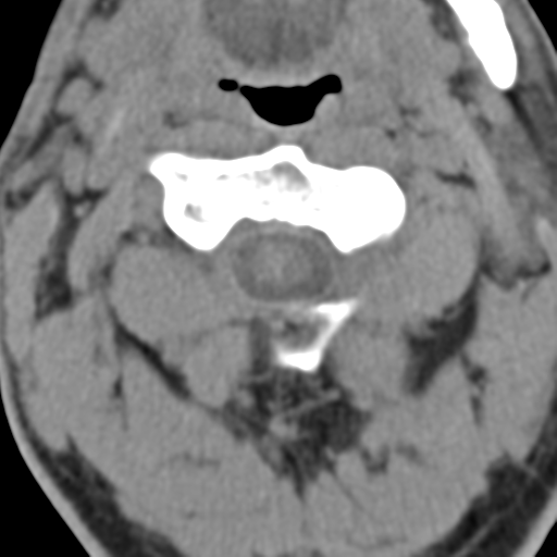 File:Cavernoma of cervical cord (Radiopaedia 50838-56346 Coronal non-contrast 3).png