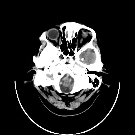 File:Cavernoma with developmental venous anomaly (Radiopaedia 22470-22506 non-contrast 3).jpg
