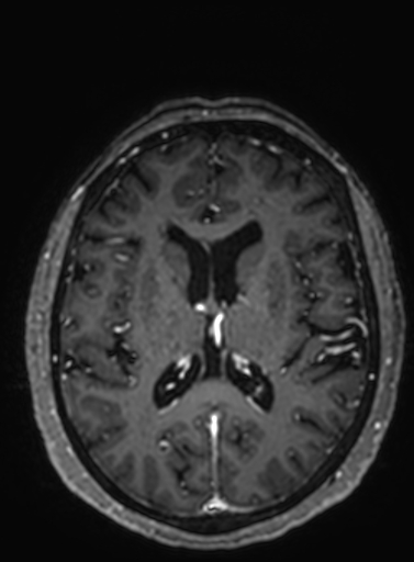 Cavernous hemangioma of the cerebellar falx (Radiopaedia 73025-83724 Axial T1 C+ 146).jpg