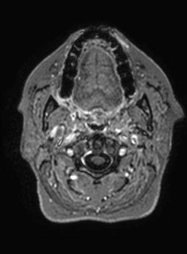 Cavernous hemangioma of the cerebellar falx (Radiopaedia 73025-83724 Axial T1 C+ 351).jpg