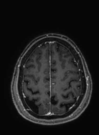 Cavernous hemangioma of the cerebellar falx (Radiopaedia 73025-83724 Axial T1 C+ 76).jpg