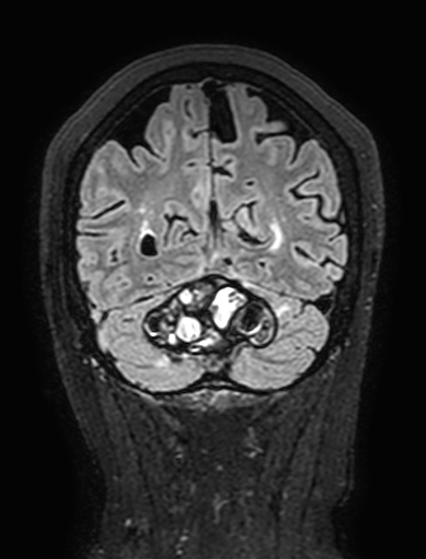 Cavernous hemangioma of the cerebellar falx (Radiopaedia 73025-83724 Coronal FLAIR 278).jpg
