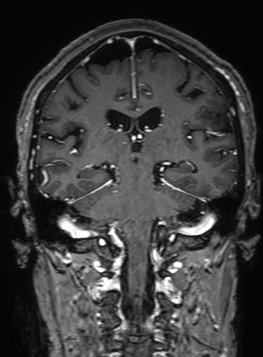 Cavernous hemangioma of the cerebellar falx (Radiopaedia 73025-83724 Coronal T1 C+ 225).jpg