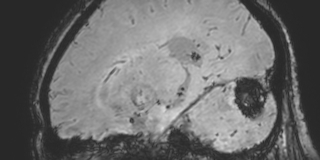 File:Cavernous hemangioma of the cerebellar falx (Radiopaedia 73025-83724 Sagittal BOLD 131).jpg
