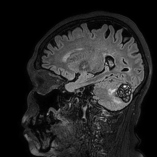 Cavernous hemangioma of the cerebellar falx (Radiopaedia 73025-83724 Sagittal FLAIR 145).jpg