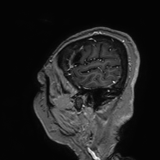 File:Cavernous hemangioma of the cerebellar falx (Radiopaedia 73025-83724 Sagittal T1 C+ 23).jpg