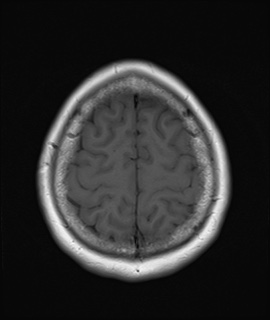 File:Cavernous sinus meningioma (Radiopaedia 63682-72367 Axial T1 19).jpg