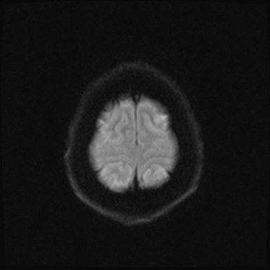 Cavernous sinus meningioma (Radiopaedia 63682-72367 DWI 40).jpg