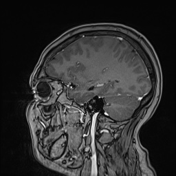 Cavernous sinus meningioma (Radiopaedia 63682-72367 Sagittal T1 C+ 121).jpg