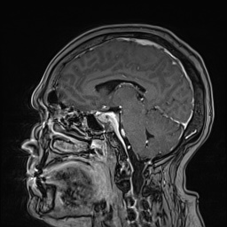 Cavernous sinus meningioma (Radiopaedia 63682-72367 Sagittal T1 C+ 98).jpg