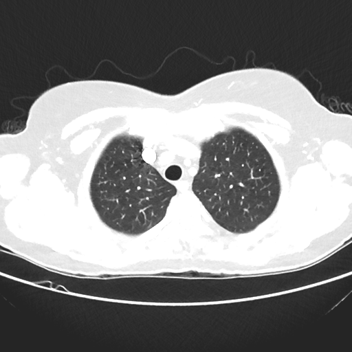 File:Cavitating lung mass - squamous cell carcinoma (Radiopaedia 48047-52854 Axial lung window 11).png
