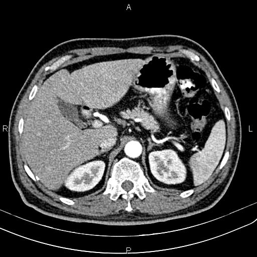 Cecal cancer with appendiceal mucocele (Radiopaedia 91080-108651 A 67).jpg