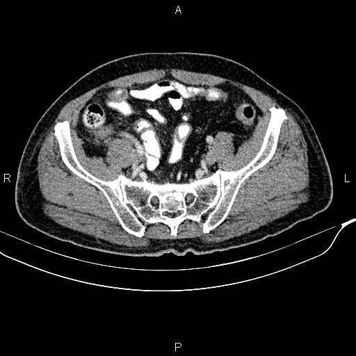 File:Cecal cancer with appendiceal mucocele (Radiopaedia 91080-108651 B 82).jpg