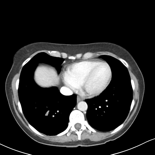 Cecal internal hernia through the foramen of Winslow (Radiopaedia 44820-48651 B 3).png