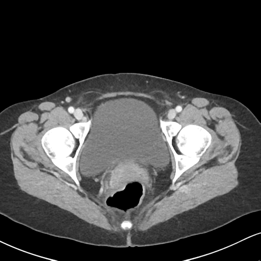Cecal internal hernia through the foramen of Winslow (Radiopaedia 44820-48651 B 73).png