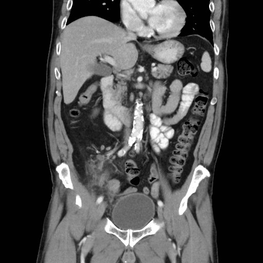 Cecal mass causing appendicitis (Radiopaedia 59207-66531 B 24).jpg