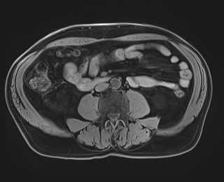 Cecal mass causing appendicitis (Radiopaedia 59207-66532 Axial T1 78).jpg