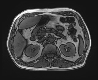 Cecal mass causing appendicitis (Radiopaedia 59207-66532 D 50).jpg