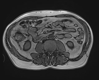 Cecal mass causing appendicitis (Radiopaedia 59207-66532 D 74).jpg