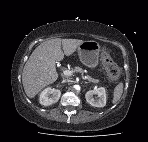 Celiac artery severe stenosis and dissection (Radiopaedia 44128-47842 B 28).jpg