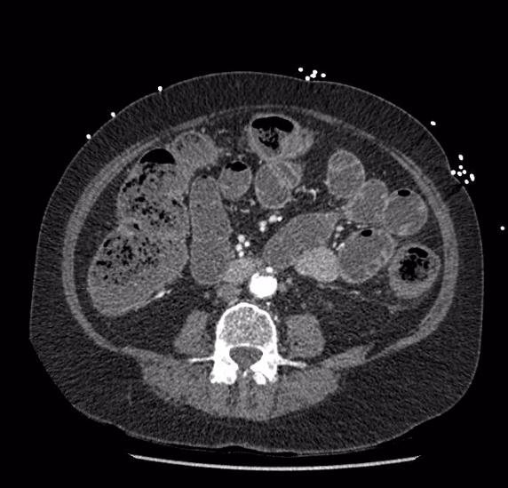 Celiac artery severe stenosis and dissection (Radiopaedia 44128-47842 B 53).jpg