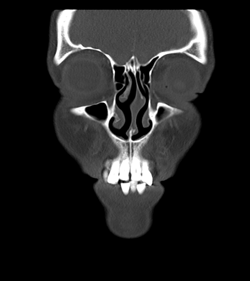 Cemento-ossifying fibroma (Radiopaedia 46243-50643 Coronal bone window 14).png
