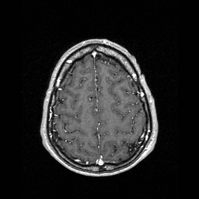 Central-variant posterior reversible encephalopathy syndrome (PRES) (Radiopaedia 43880-47358 Axial T1 C+ 139).jpg