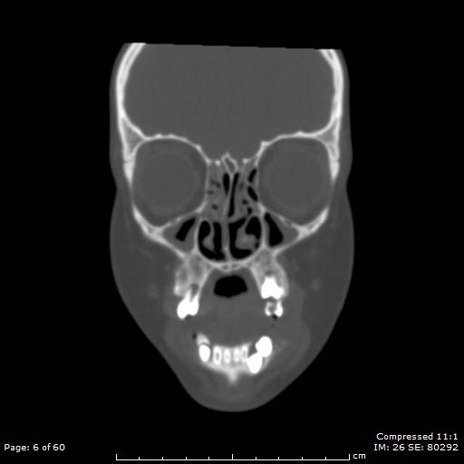 File:Central giant cell granuloma (Radiopaedia 45612-49754 Coronal bone window 6).jpg