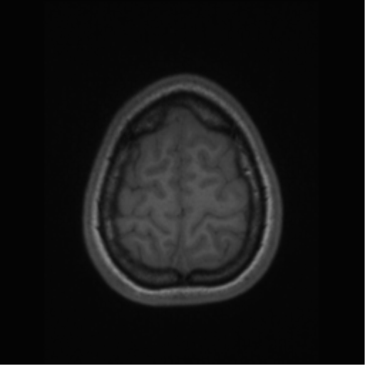 File:Central neurocytoma (Radiopaedia 37664-39557 Axial T1 65).png