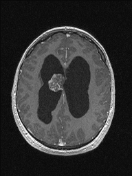 Central neurocytoma (Radiopaedia 56690-63469 Axial T1 C+ 115).jpg