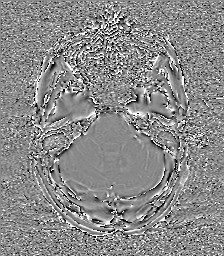 Central neurocytoma (Radiopaedia 84497-99872 Axial 18).jpg