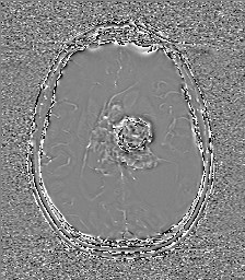 File:Central neurocytoma (Radiopaedia 84497-99872 Axial 41).jpg