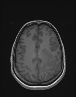 Central neurocytoma (Radiopaedia 84497-99872 Axial T1 144).jpg