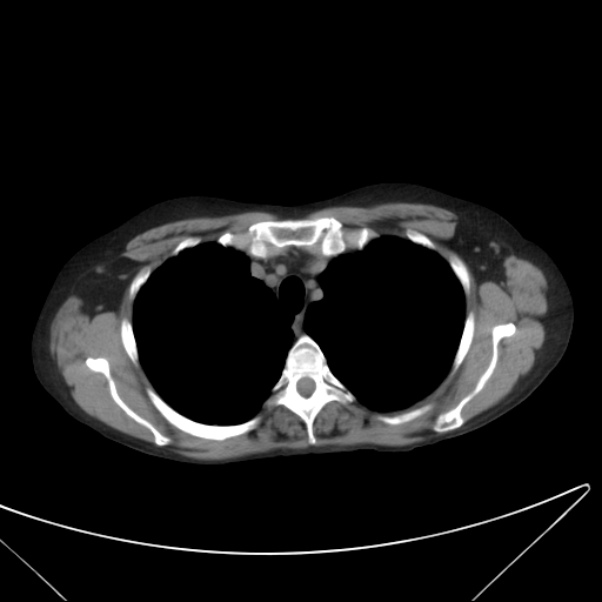 Centrilobular pulmonary emphysema (Radiopaedia 24495-24789 Axial non-contrast 9).jpg