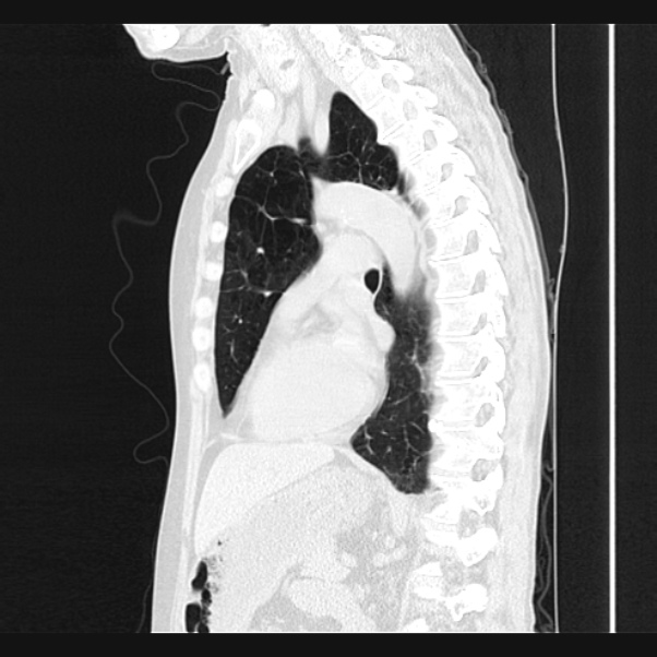 Centrilobular pulmonary emphysema (Radiopaedia 24495-24789 Sagittal lung window 48).jpg