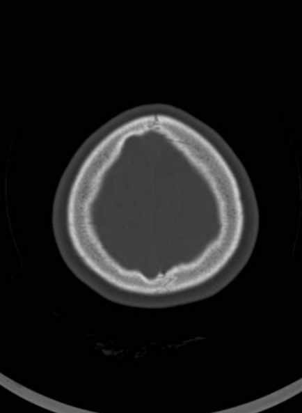 Cerebellar abscess (Radiopaedia 73727-84527 Axial bone window 59).jpg